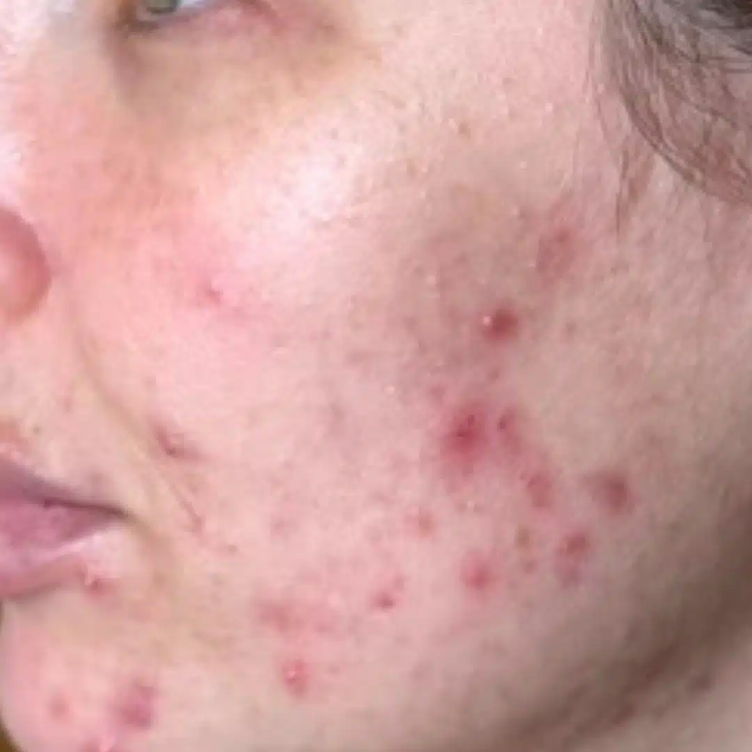 Chanand skincare comparison: before, as published by Chanand