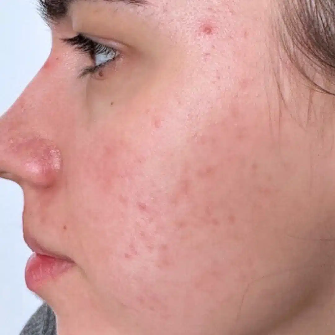 Chanand skincare comparison: after, as published by Chanand