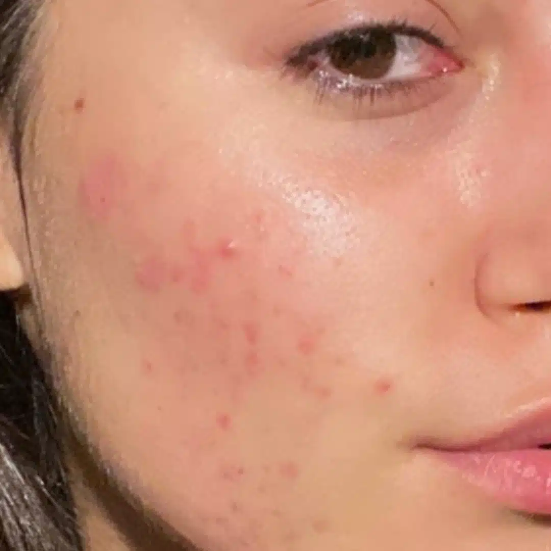 Chanand skincare comparison: before, as published by Chanand