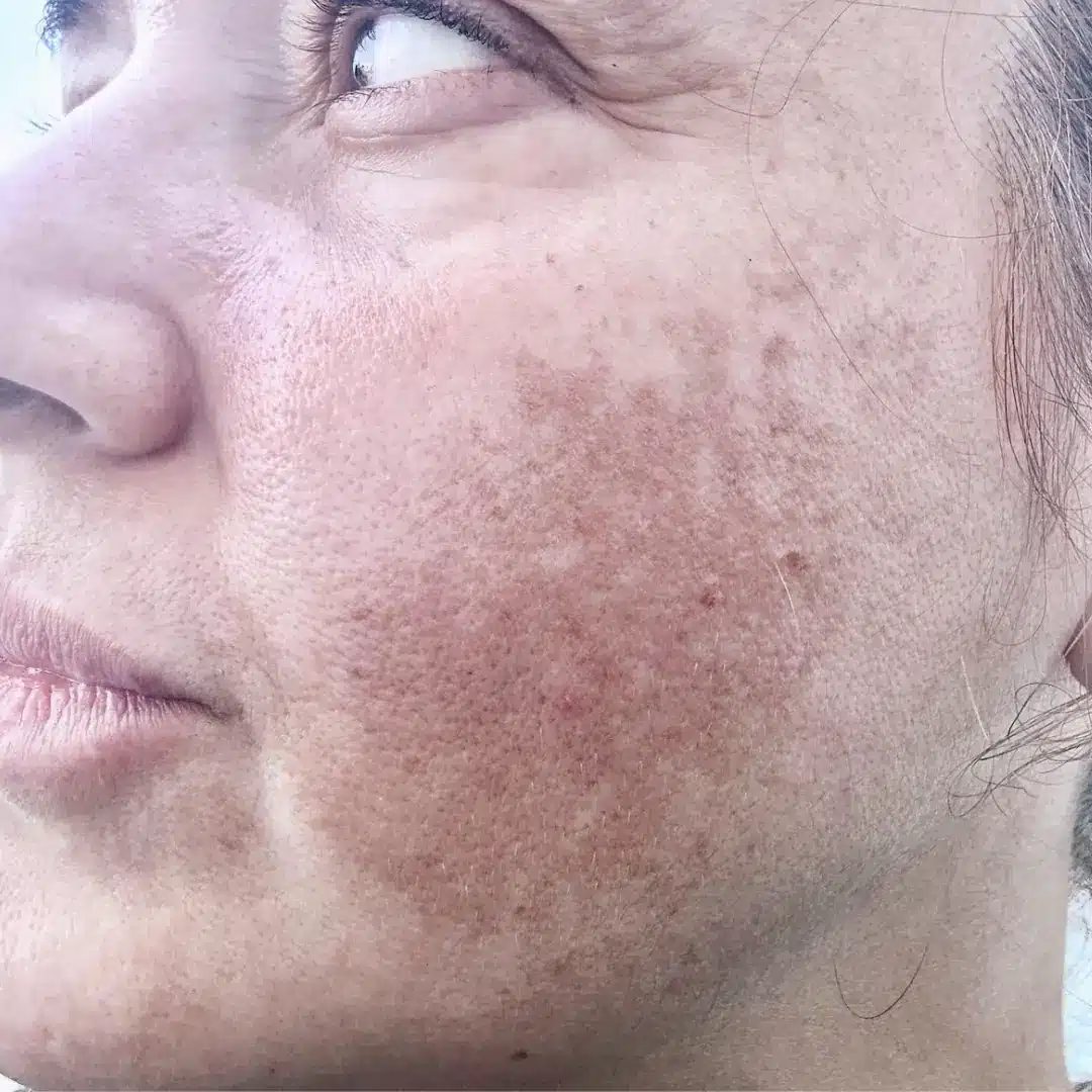 Chanand skincare comparison: before, as published by Chanand