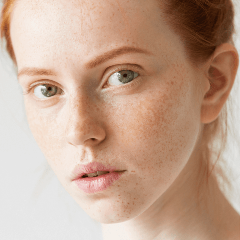 Chanand Hiperpigmentation