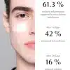 AFC-Acne-Face-Cream-eficacy_Chanand ACNE FACE CREAM