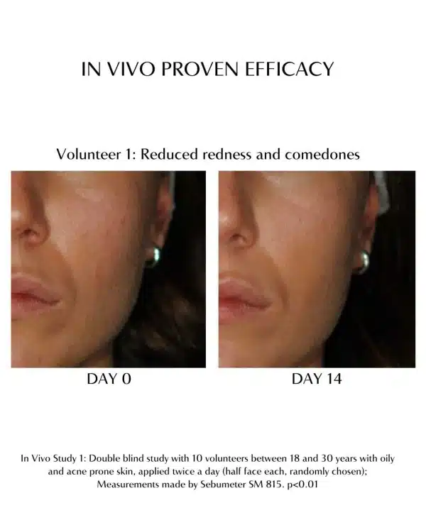 afc-acne-face-cream-chanand-in-vivo-studies ACNE FACE CREAM